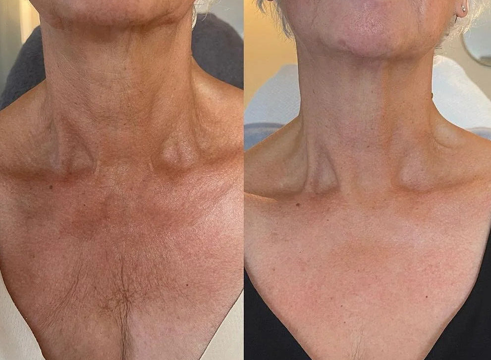 KrX Neck Lift Intensive Firming Cream