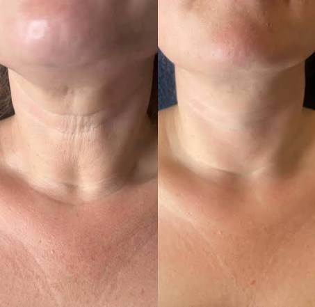 KrX Neck Lift Intensive Firming Cream