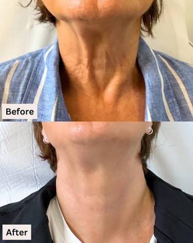 KrX Neck Lift Intensive Firming Cream